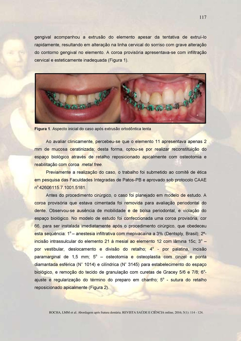 Aspecto inicial do caso após extrusão ortodôntica lenta Ao avaliar clinicamente, percebeu-se que o elemento 11 apresentava apenas 2 mm de mucosa ceratinizada; desta forma, optou-se por realizar