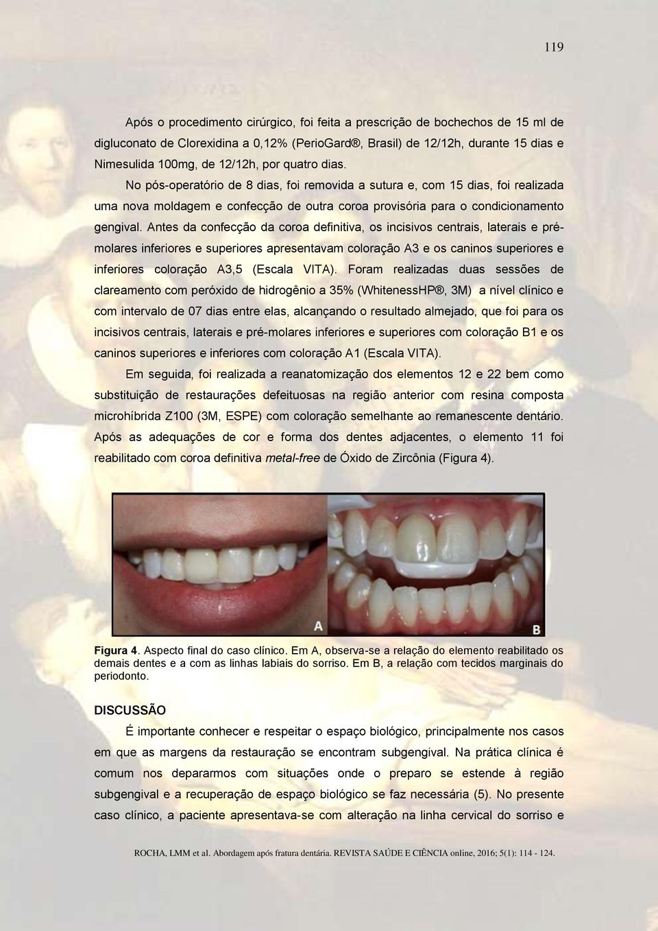 Antes da confecção da coroa definitiva, os incisivos centrais, laterais e prémolares inferiores e superiores apresentavam coloração A3 e os caninos superiores e inferiores coloração A3,5 (Escala