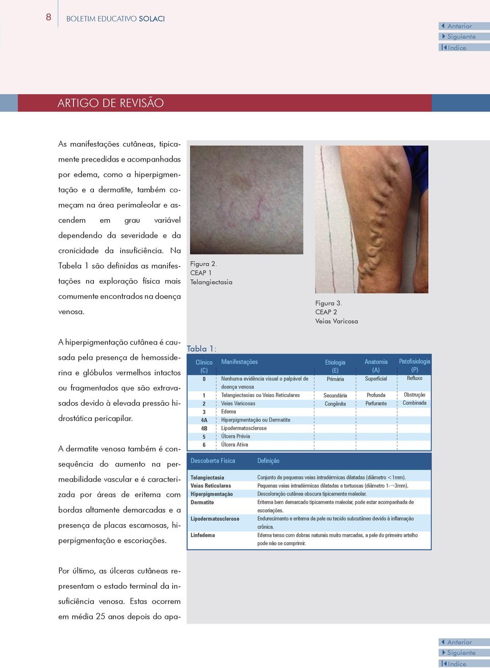 Figura 2. CEAP 1 Telangiectasia Figura 3.