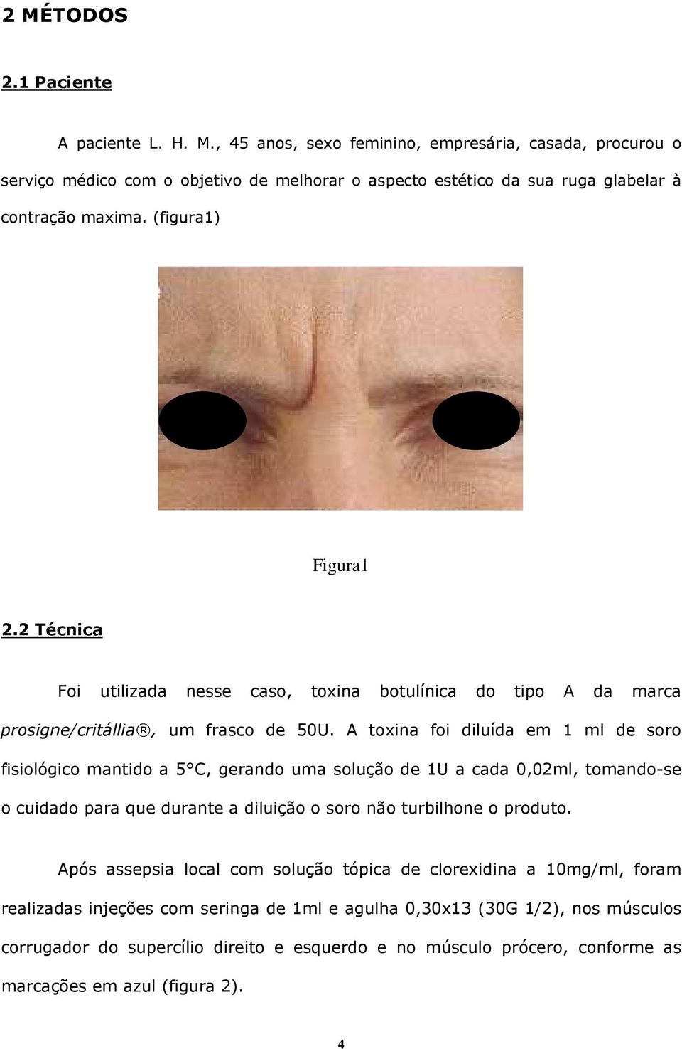 A toxina foi diluída em 1 ml de soro fisiológico mantido a 5 C, gerando uma solução de 1U a cada 0,02ml, tomando-se o cuidado para que durante a diluição o soro não turbilhone o produto.