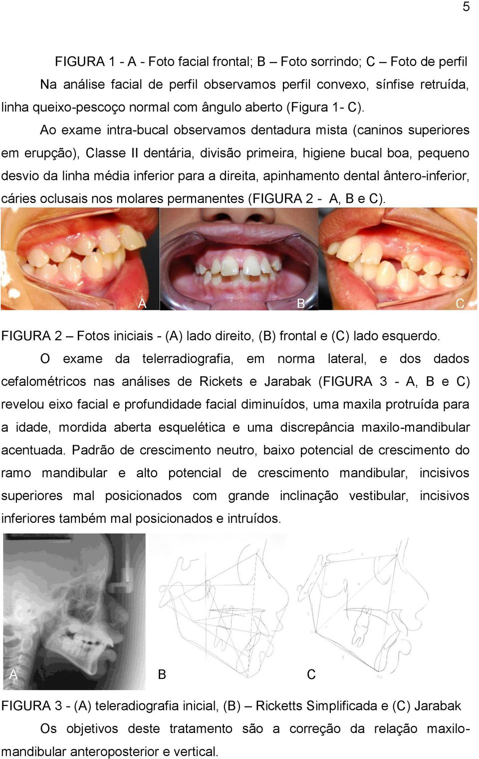 Ao exame intra-bucal observamos dentadura mista (caninos superiores em erupção), Classe II dentária, divisão primeira, higiene bucal boa, pequeno desvio da linha média inferior para a direita,