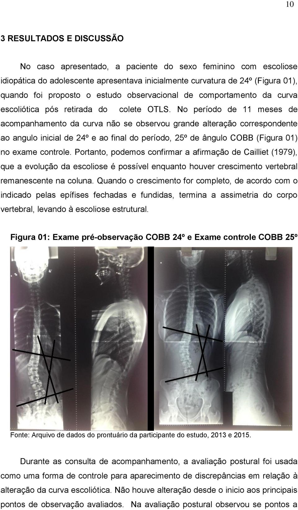 No período de 11 meses de acompanhamento da curva não se observou grande alteração correspondente ao angulo inicial de 24º e ao final do período, 25º de ângulo COBB (Figura 01) no exame controle.