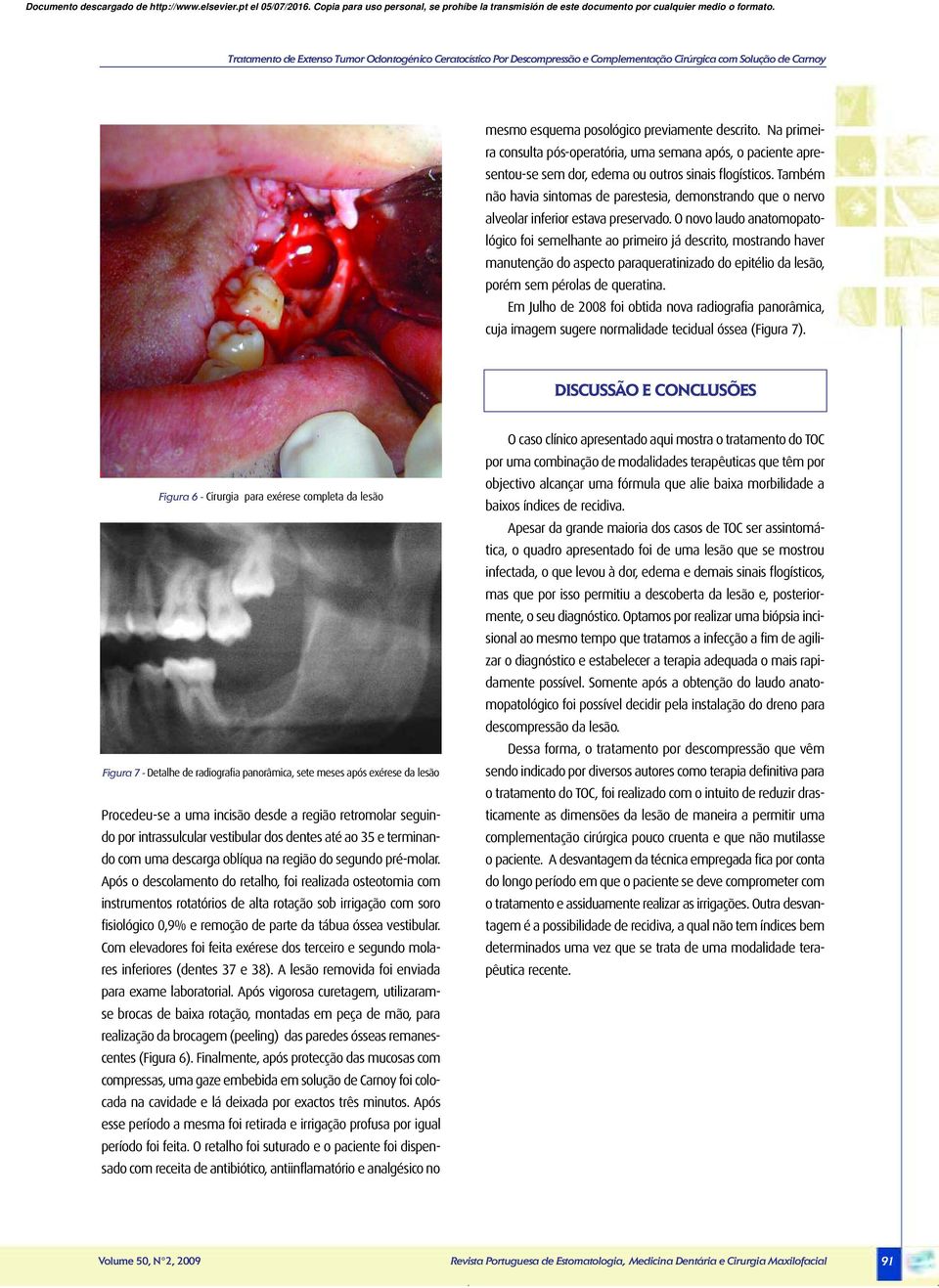 Também não havia sintomas de parestesia, demonstrando que o nervo alveolar inferior estava preservado.