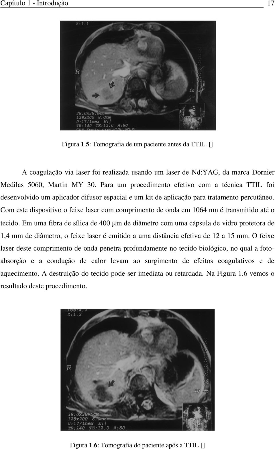 Com este dispositivo o feixe laser com comprimento de onda em 1064 nm é transmitido até o tecido.