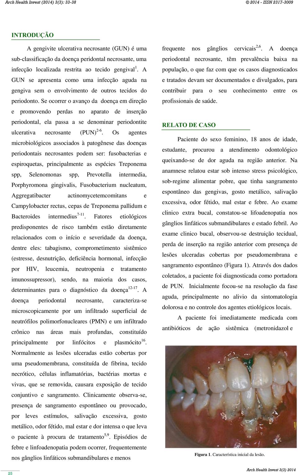 Se ocorrer o avanço da doença em direção e promovendo perdas no aparato de inserção periodontal, ela passa a se denominar periodontite ulcerativa necrosante (PUN) 2-6.
