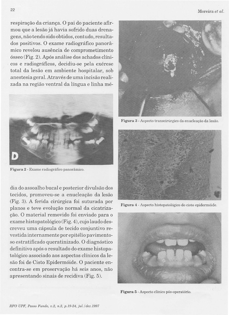 Após análise dos achados clínicos e radiográficos, decidiu-se pela exérese total da lesão em ambiente hospitalar, sob anestesia geral.