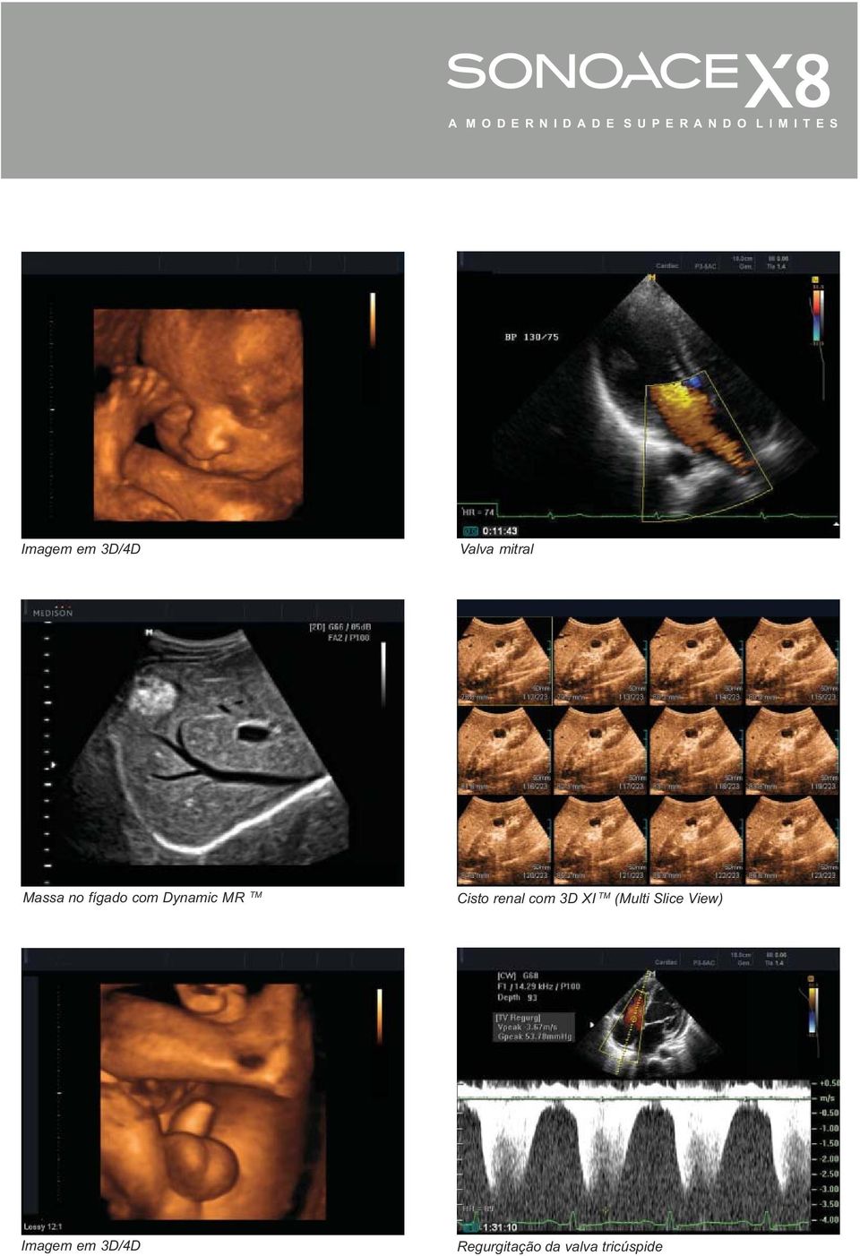 Dynamic MR TM Cisto renal com 3D XI TM (Multi Slice