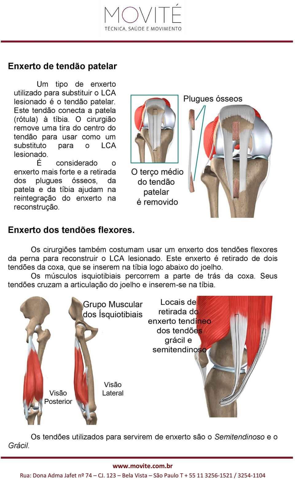 É considerado o enxerto mais forte e a retirada dos plugues ósseos, da patela e da tíbia ajudam na reintegração do enxerto na reconstrução. Enxerto dos tendões flexores.