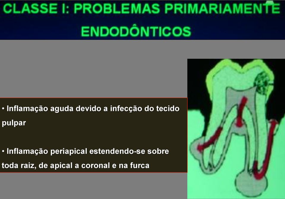 Inflamação periapical