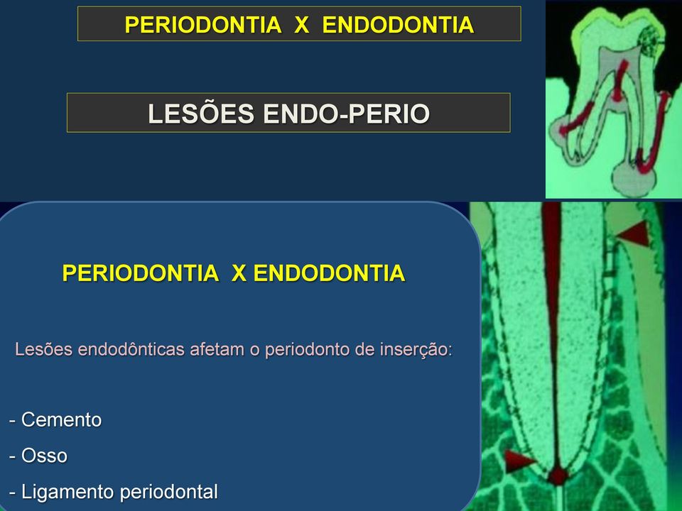 Lesões endodônticas afetam o periodonto