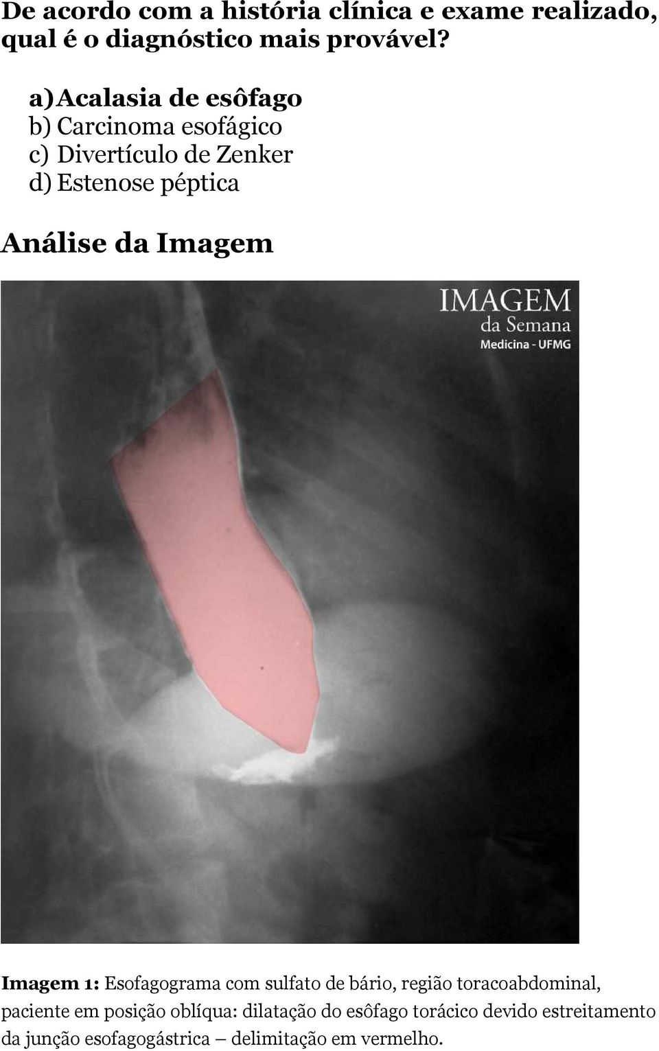 da Imagem Imagem 1: Esofagograma com sulfato de bário, região toracoabdominal, paciente em posição