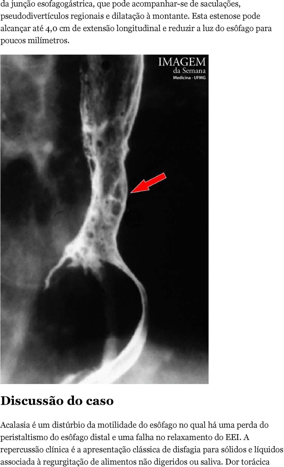 Discussão do caso Acalasia é um distúrbio da motilidade do esôfago no qual há uma perda do peristaltismo do esôfago distal e uma falha no