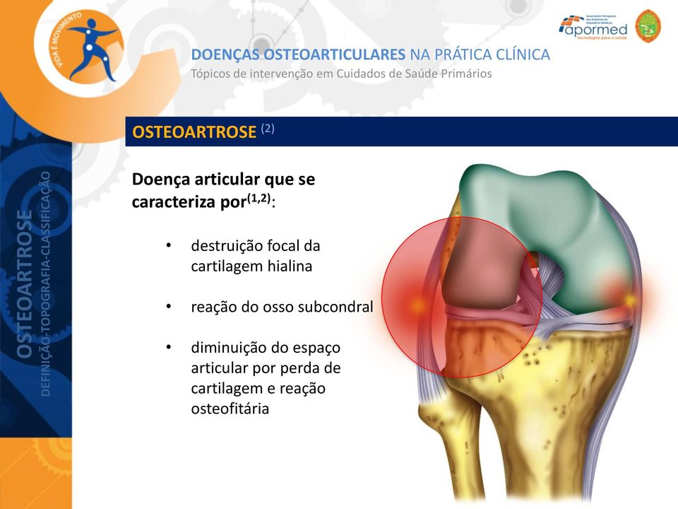 focal da cartilagem hialina reação do osso subcondral