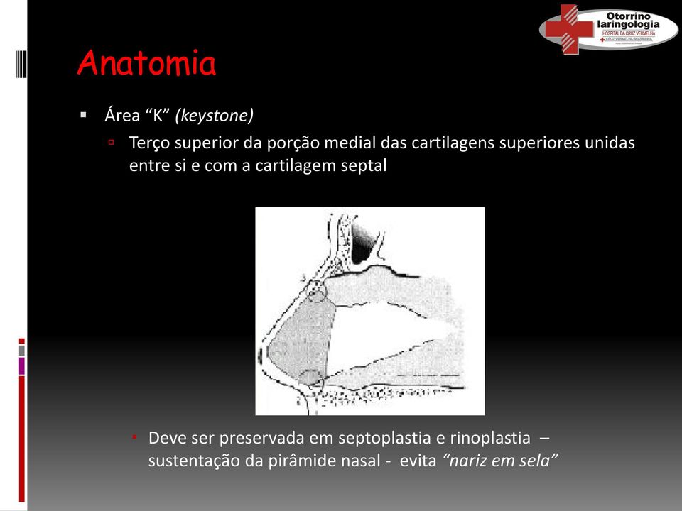 cartilagem septal Deve ser preservada em septoplastia