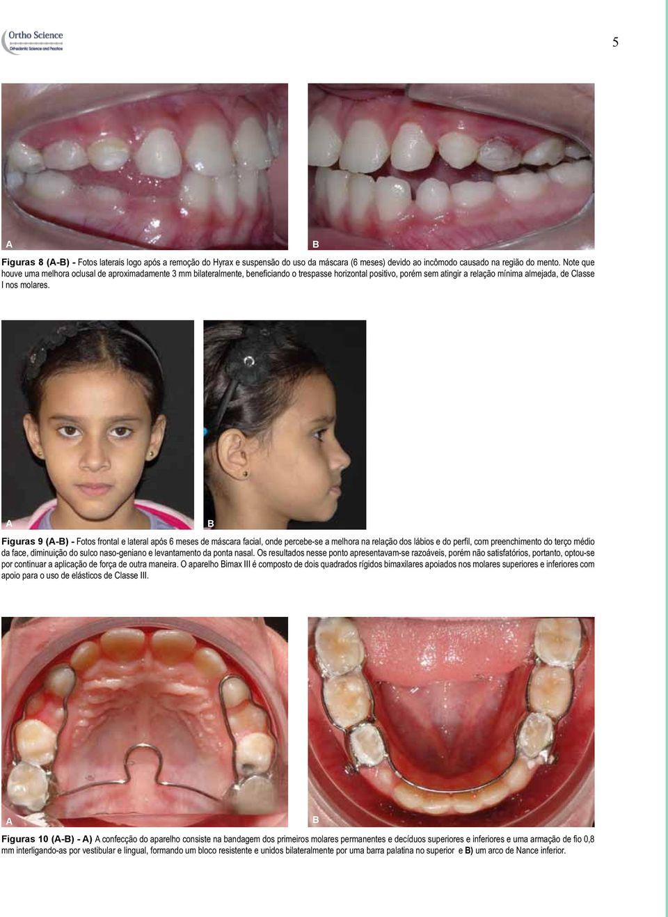 Figuras 9 (-) - Fotos frontal e lateral após 6 meses de máscara facial, onde percebe-se a melhora na relação dos lábios e do perfil, com preenchimento do terço médio da face, diminuição do sulco