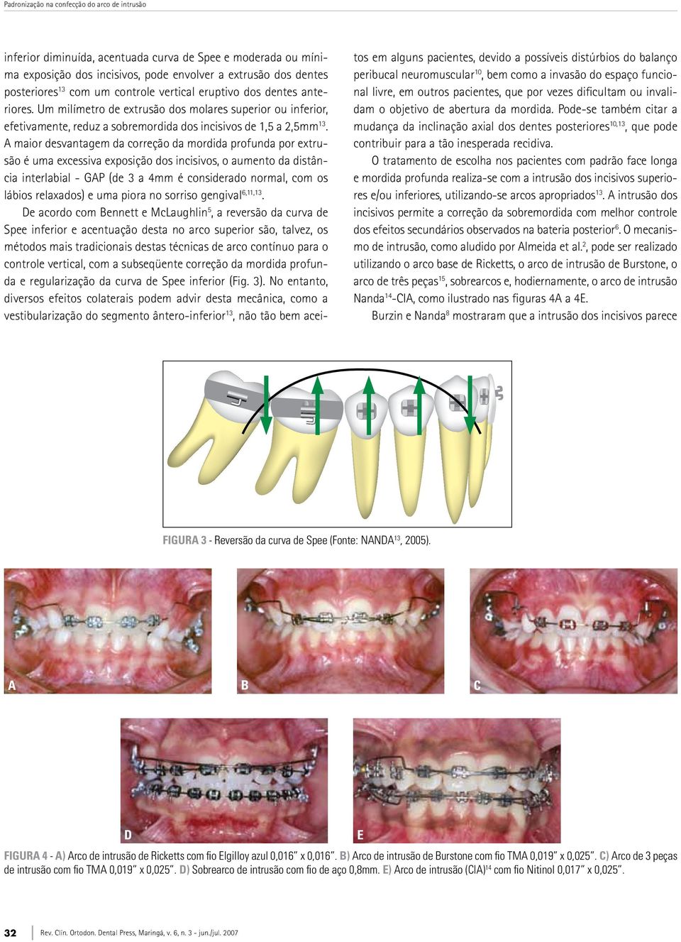 A maior desvantagem da correção da mordida profunda por extrusão é uma excessiva exposição dos incisivos, o aumento da distância interlabial - GAP (de 3 a 4mm é considerado normal, com os lábios