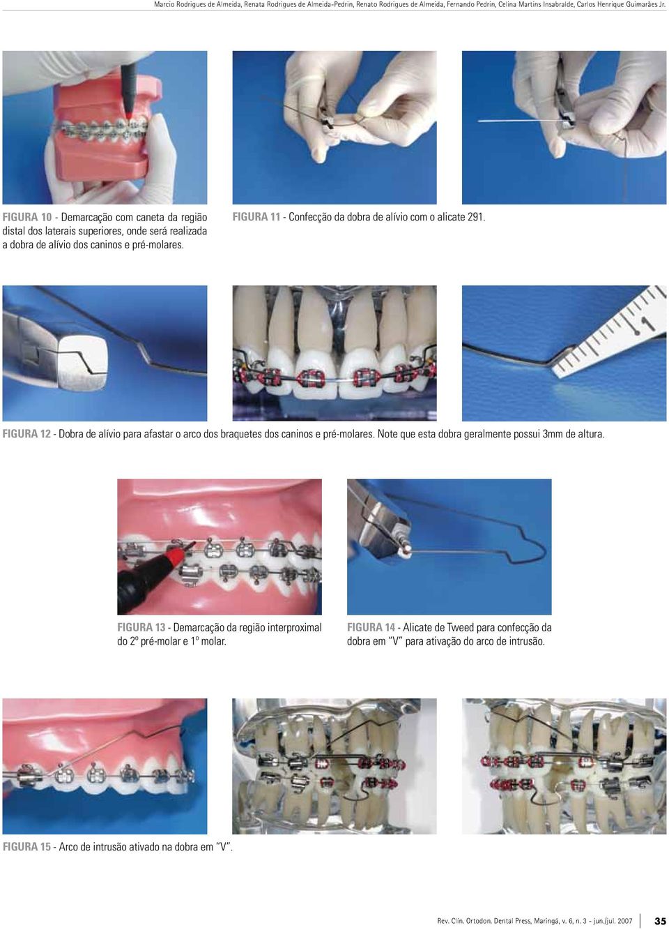 Figura 12 - Dobra de alívio para afastar o arco dos braquetes dos caninos e pré-molares. Note que esta dobra geralmente possui 3mm de altura.