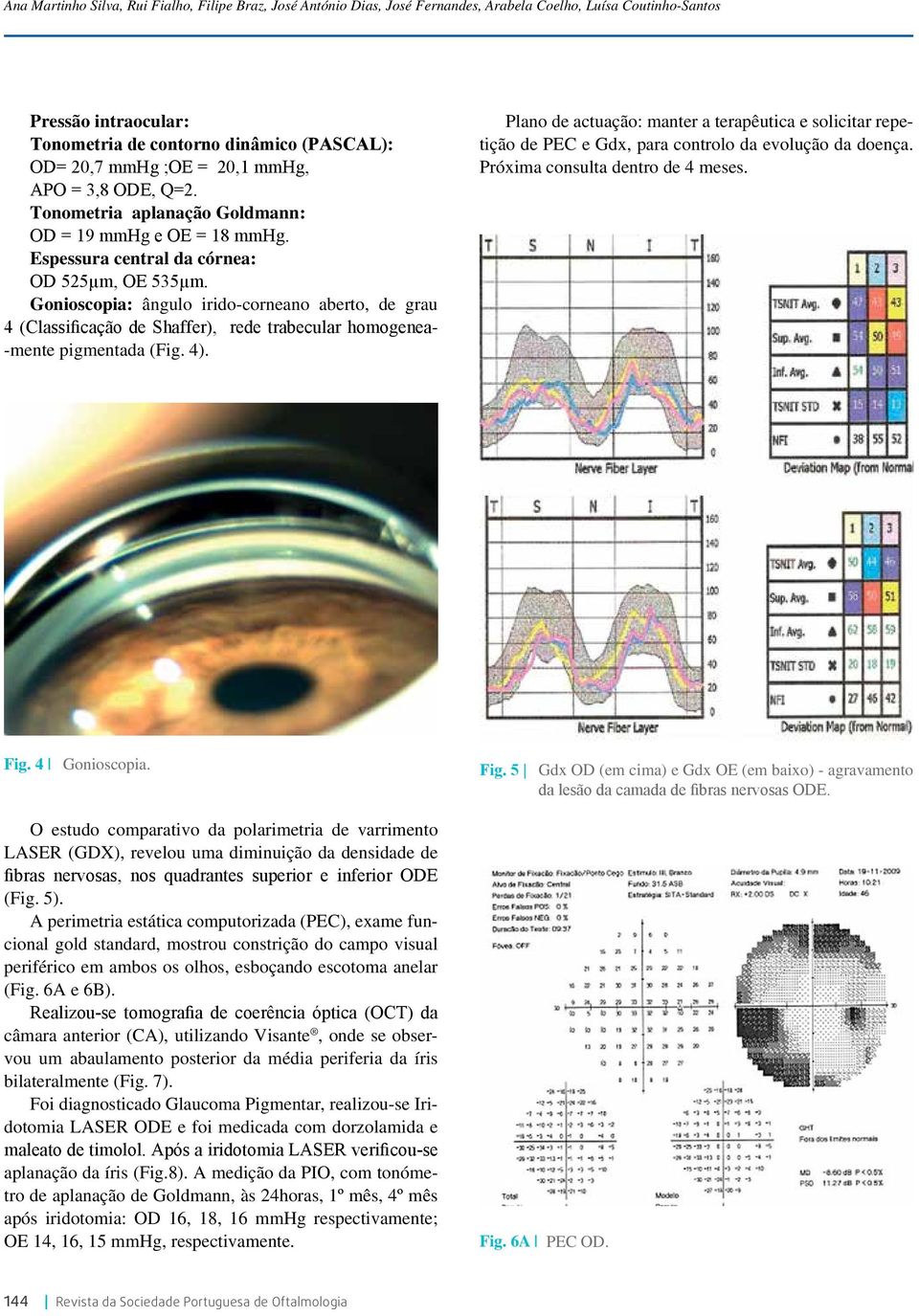 Gonioscopia: ângulo irido-corneano aberto, de grau 4 (Classificação de Shaffer), rede trabecular homogenea- -mente pigmentada (Fig. 4).