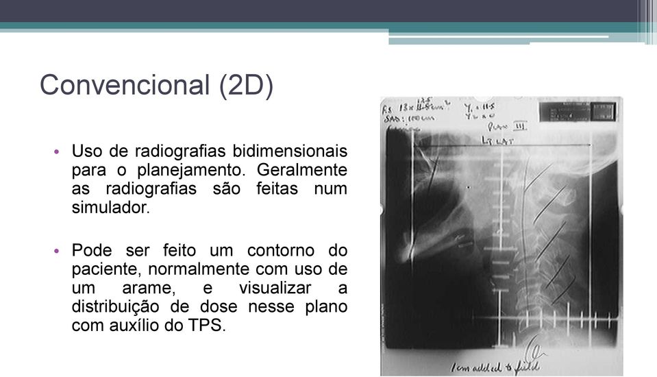 Pode ser feito um contorno do paciente, normalmente com uso de um