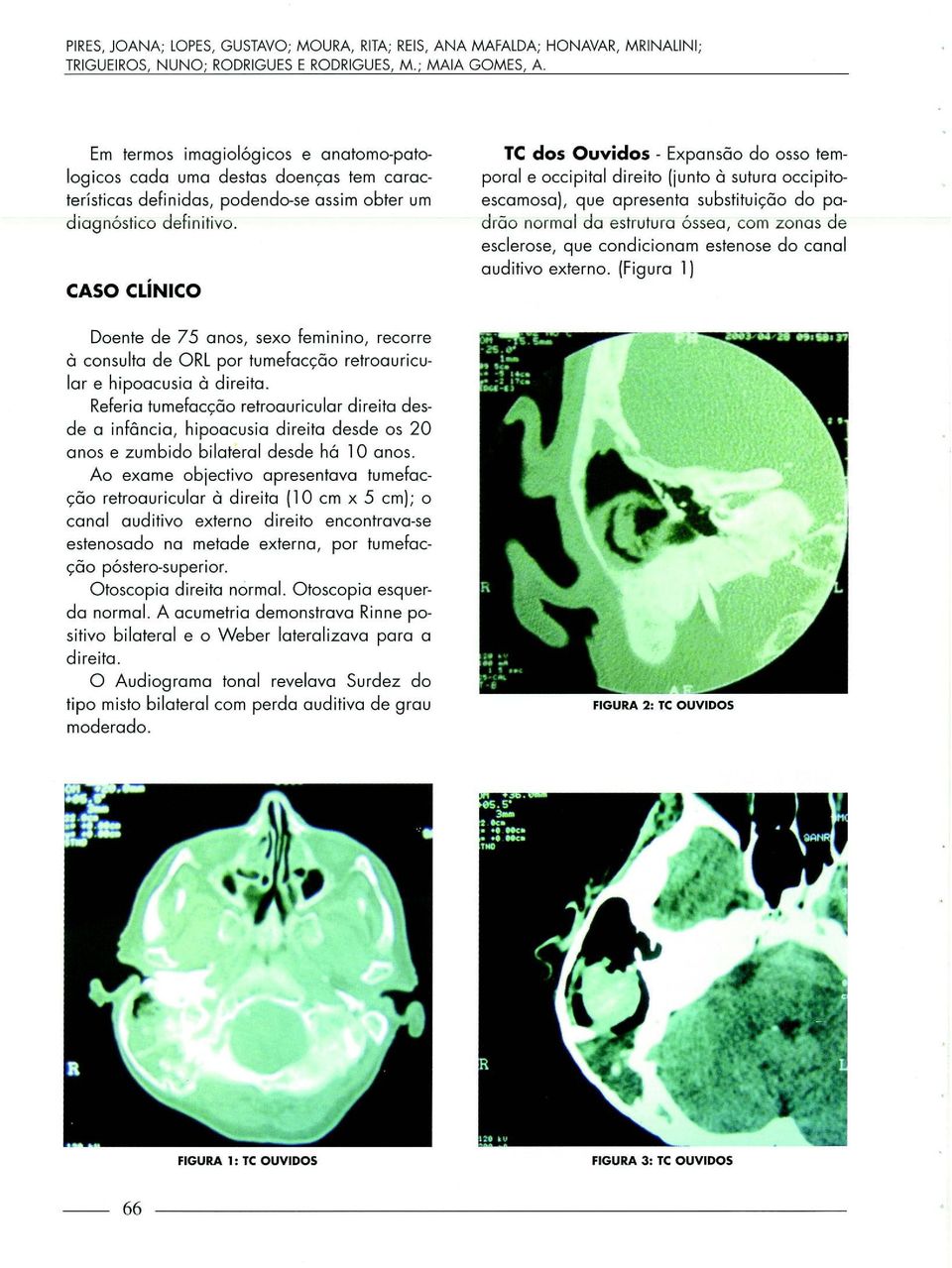 CASO CLÍNICO TC dos Ouvidos- Expansão do osso temporal e occipital direito (junto à sutura occipitoescamosa), que apresenta substituição do padrão normal da estrutura óssea, com zonas de esclerose,
