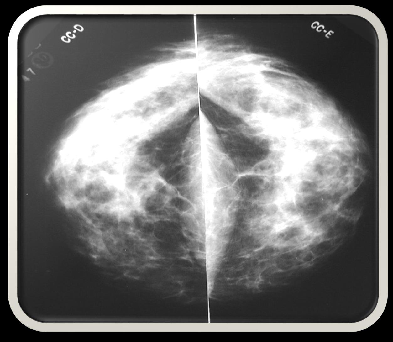 Porção lateral Radiologia Mamária Músculo grande