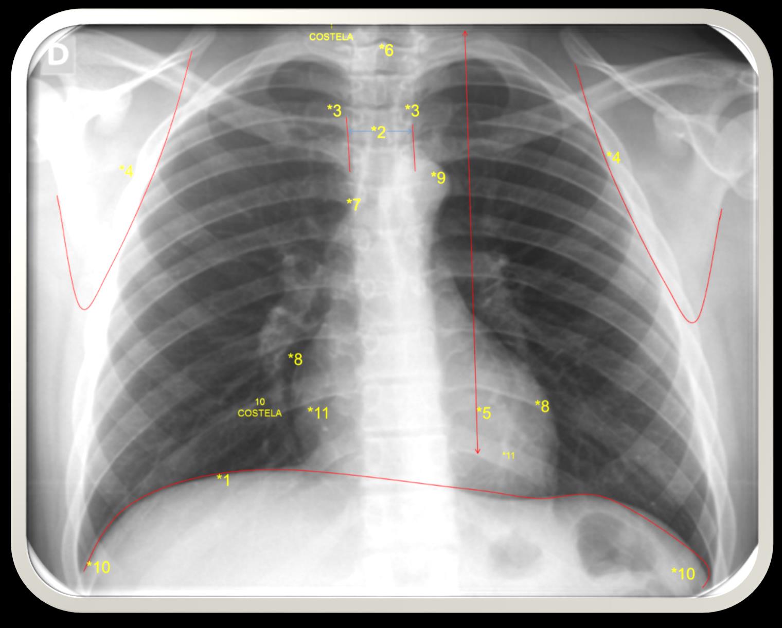 Visualização 1* diafragma 2* processo espinhoso da vertebra 3*face medial da clavícula 4*face medial da