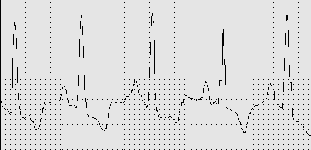 Taquicardia sinusal DII SENS N 50mm/s