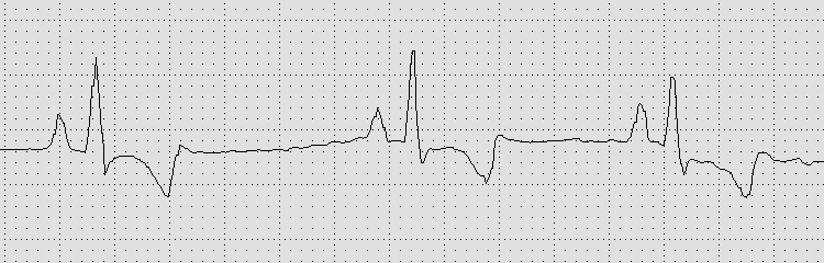 Alteração na Repolarização Ventricular