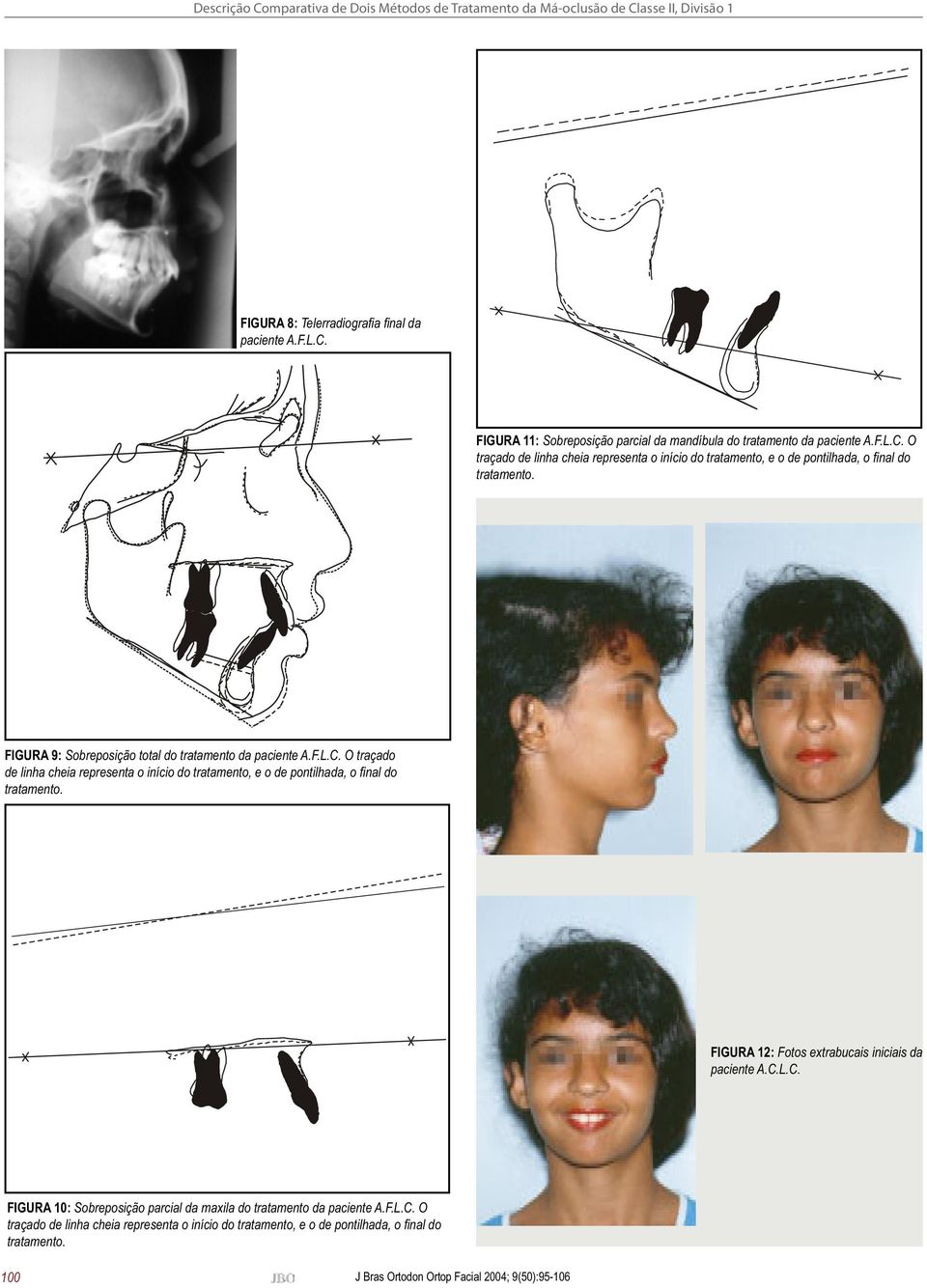 FIGURA 12: Fotos extrabucais iniciais da paciente A.C.L.C. FIGURA 10: Sobreposição parcial da maxila do tratamento da paciente A.F.L.C. O traçado de linha cheia representa o início do tratamento, e o de pontilhada, o fi nal do tratamento.