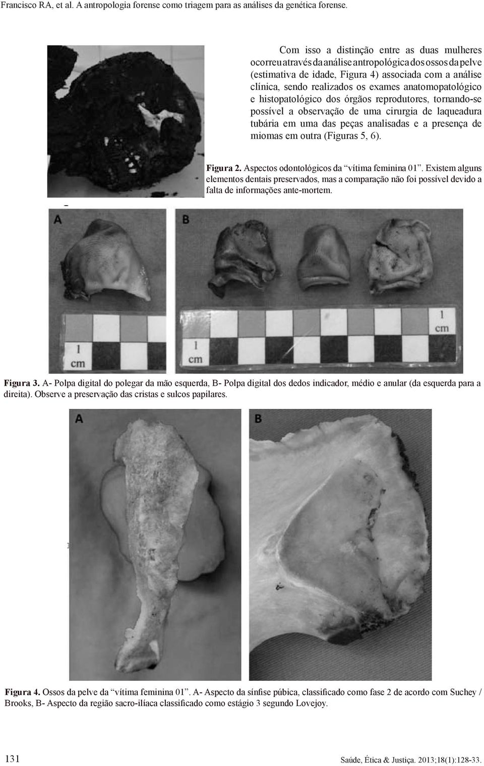 (Figuras 5, 6). Figura 2. Aspectos odontológicos da vítima feminina 01. Existem alguns elementos dentais preservados, mas a comparação não foi possível devido a falta de informações ante-mortem.