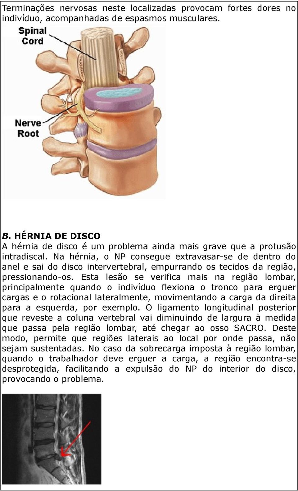 Na hérnia, o NP consegue extravasar-se de dentro do anel e sai do disco intervertebral, empurrando os tecidos da região, pressionando-os.