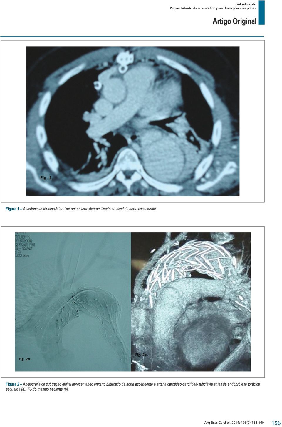 Figura 2 Angiografia de subtração digital apresentando enxerto bifurcado