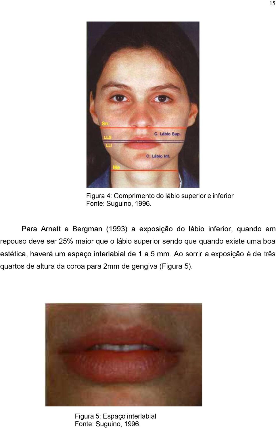 lábio superior sendo que quando existe uma boa estética, haverá um espaço interlabial de 1 a 5 mm.