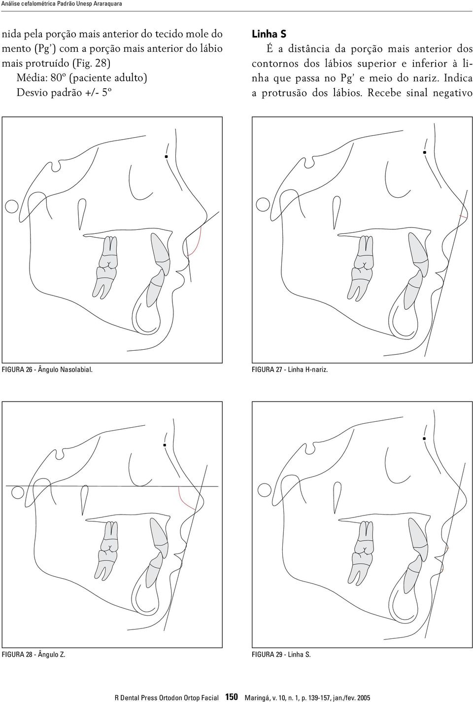 28) Média: 80º (paciente adulto) Desvio padrão +/- 5º Linha S É a distância da porção mais anterior dos contornos dos lábios superior e inferior à