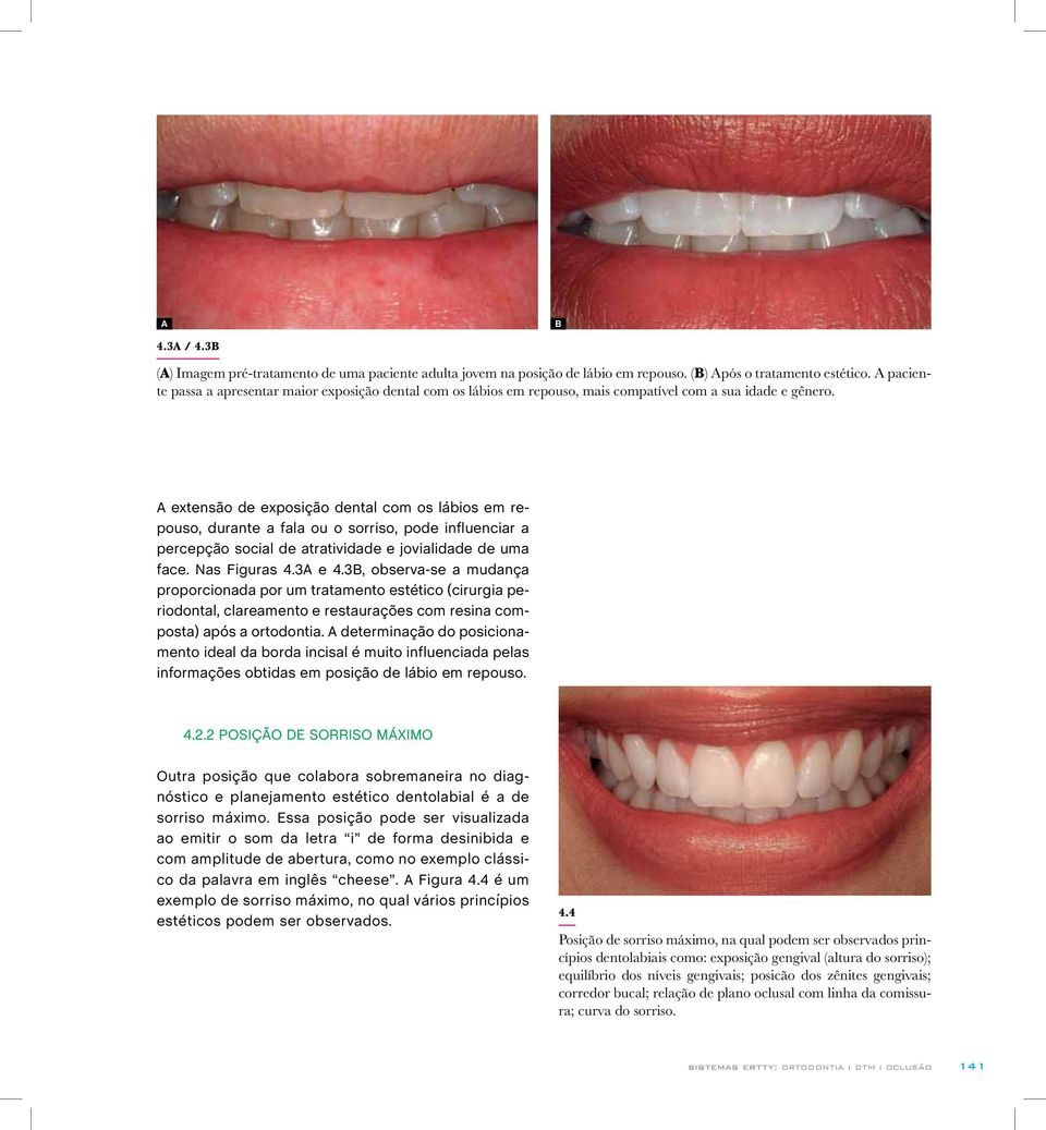 A extensão de exposição dental com os lábios em repouso, durante a fala ou o sorriso, pode influenciar a percepção social de atratividade e jovialidade de uma face. Nas Figuras 4.3A e 4.
