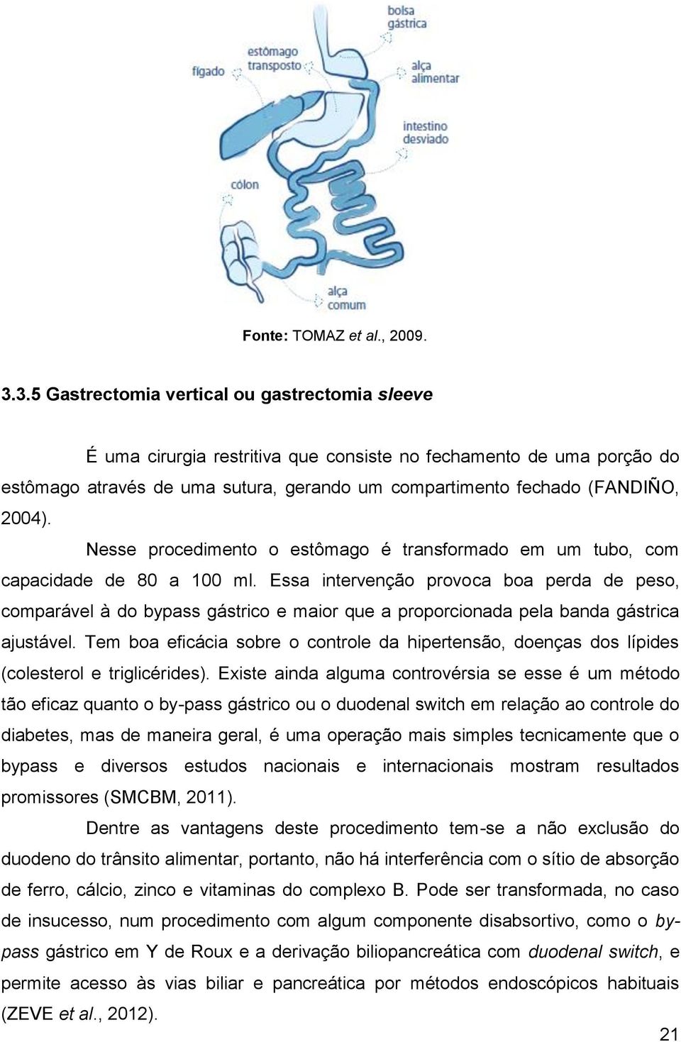 Nesse procedimento o estômago é transformado em um tubo, com capacidade de 80 a 100 ml.