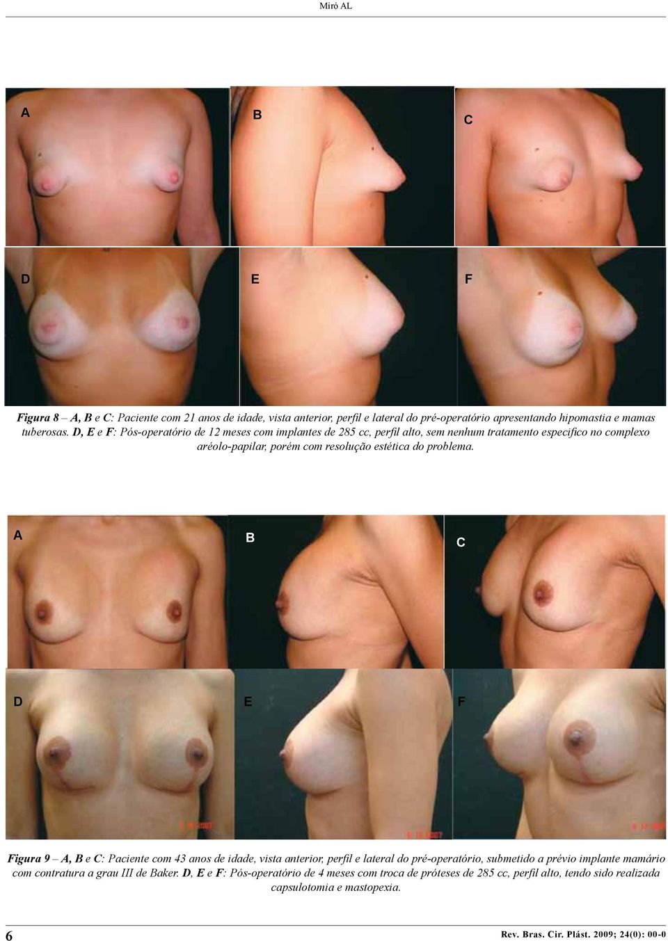 A b C D E F Figura 9 A, B e C: Paciente com 43 anos de idade, vista anterior, perfil e lateral do pré-operatório, submetido a prévio implante mamário com contratura a grau III de