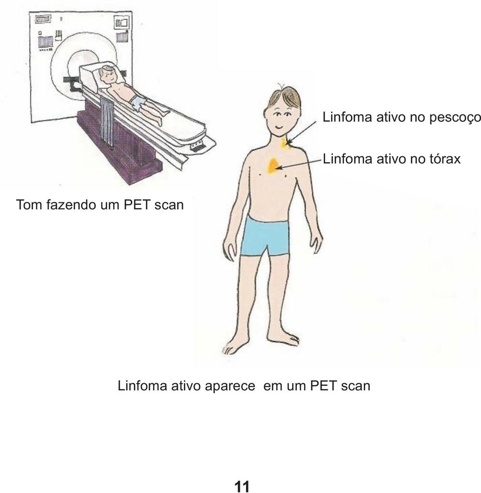 fazendo um PET scan Linfoma