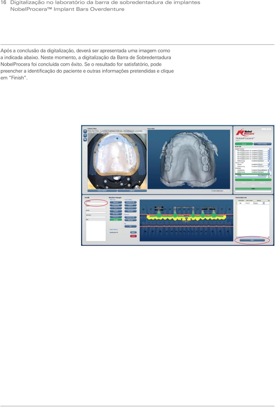 Neste momento, a digitalização da Barra de Sobredentadura NobelProcera foi concluída com êxito.