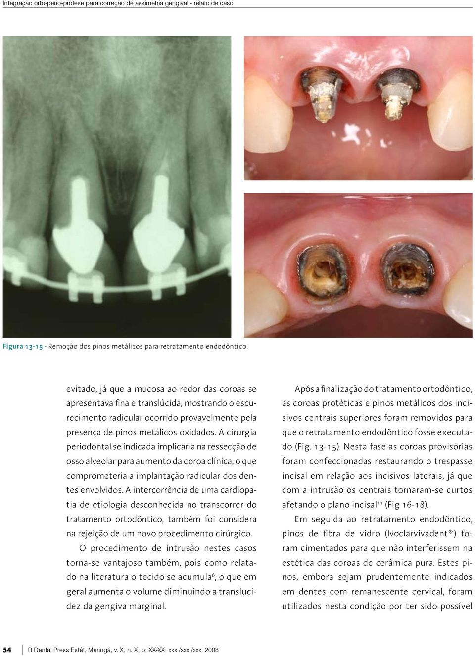 A cirurgia periodontal se indicada implicaria na ressecção de osso alveolar para aumento da coroa clínica, o que comprometeria a implantação radicular dos dentes envolvidos.