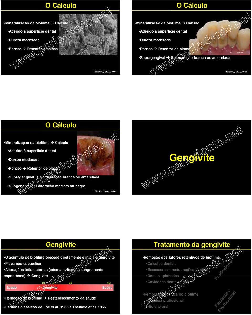 Dureza moderada Poroso Retentor de placa Gengivite Supragengival Colocaração branca ou amarelada Subgengival Coloração marrom ou negra (Lindhe, J et al, 2004) Gengivite O acúmulo de biofilme precede