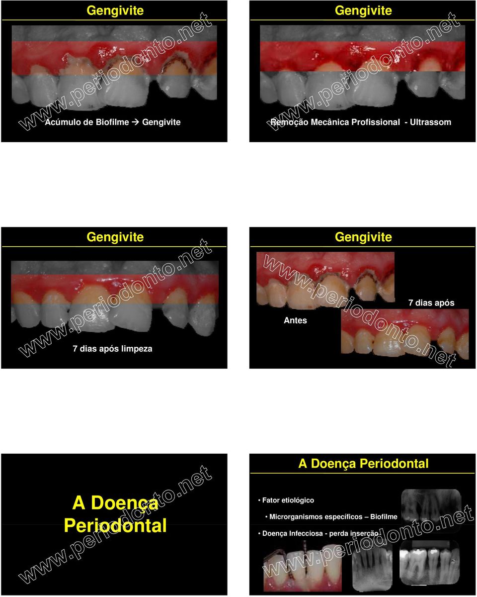 após limpeza A Doença Periodontal A Doença Periodontal Fator