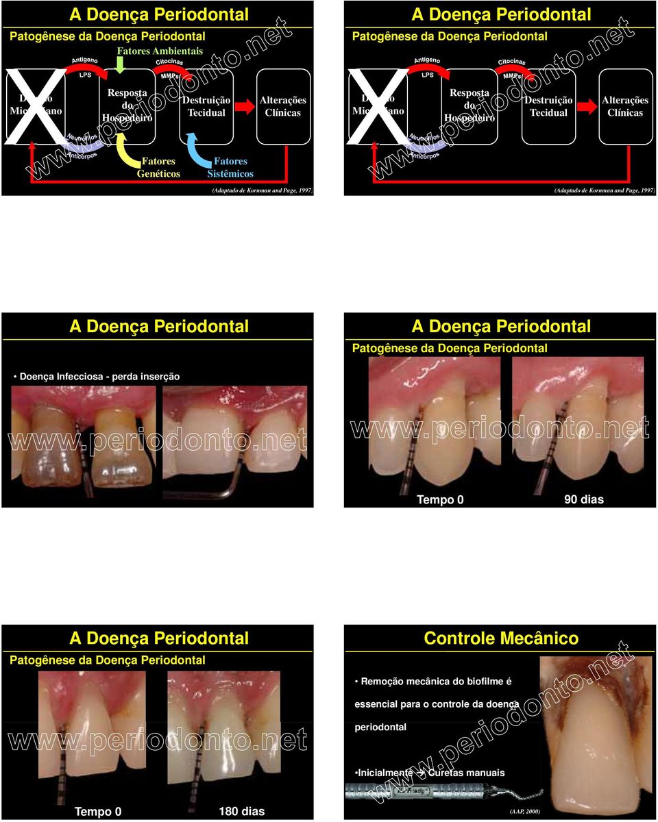 1997) (Adaptado de Kornman and Page, 1997) A Doença Periodontal A Doença Periodontal Patogênese da Doença Periodontal Doença Infecciosa - perda inserção Tempo 0 90 dias A Doença