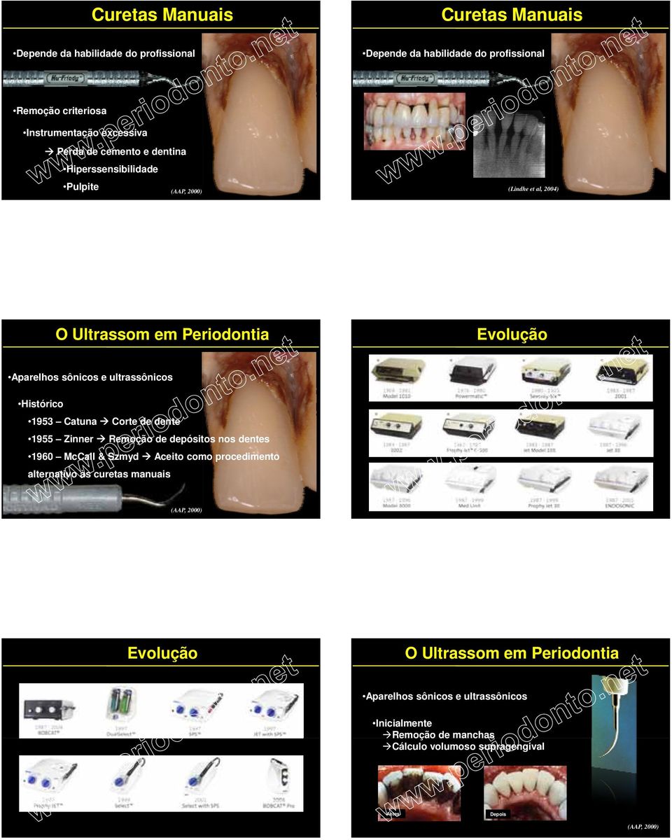 Histórico 1953 Catuna Corte de dente 1955 Zinner Remoção de depósitos nos dentes 1960 McCall & Szmyd Aceito como procedimento alternativo às curetas