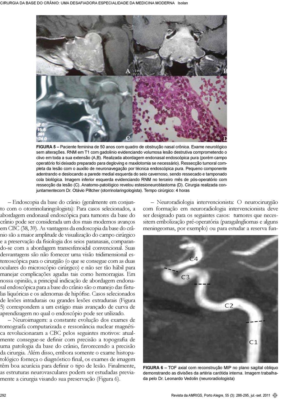 RNM em T1 com gadolínio evidenciando volumosa lesão destrutiva comprometendo o clivo em toda a sua extensão (A,B).