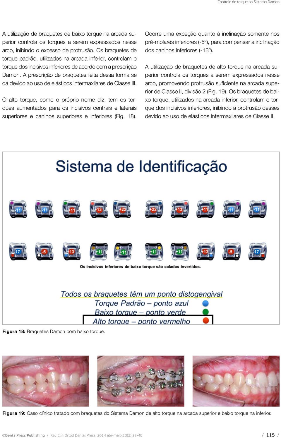 A prescrição de braquetes feita dessa forma se dá devido ao uso de elásticos intermaxilares de Classe III.