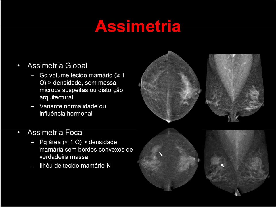 normalidade ou influência hormonal Assimetria Focal Pq área (< 1 Q) >