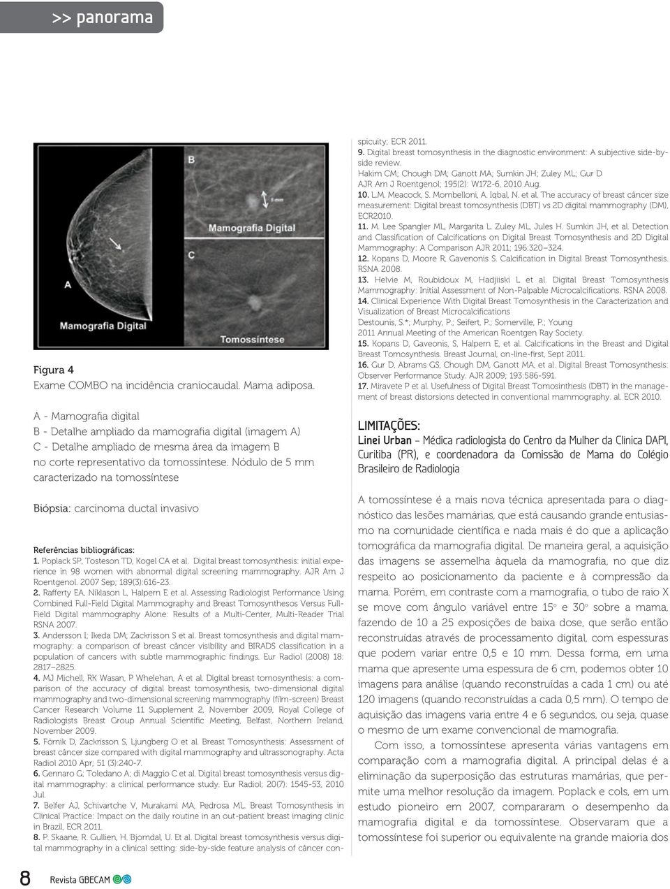 Nódulo de 5 mm caracterizado na tomossíntese Biópsia: carcinoma ductal invasivo Referências bibliográficas: 1. Poplack SP, Tosteson TD, Kogel CA et al.