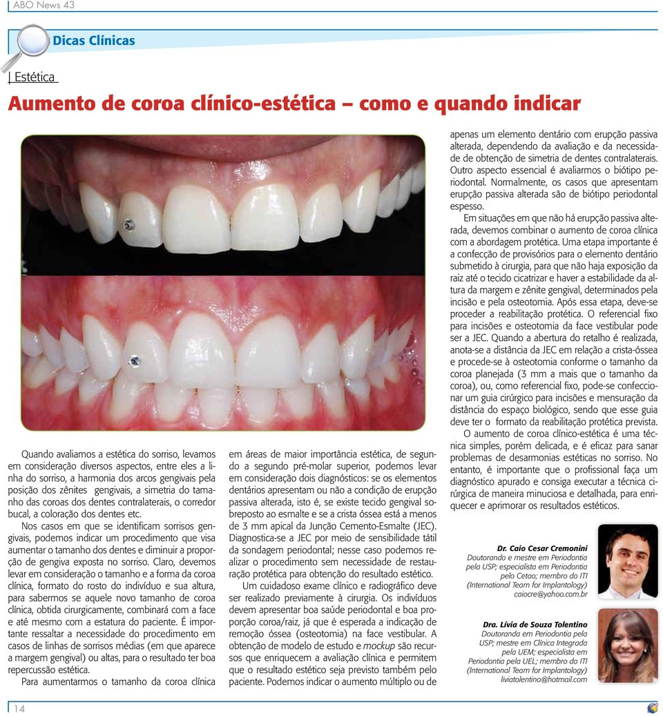 Nos casos em que se identificam sorrisos gengivais, podemos indicar um procedimento que visa aumentar o tamanho dos dentes e diminuir a proporção de gengiva exposta no sorriso.