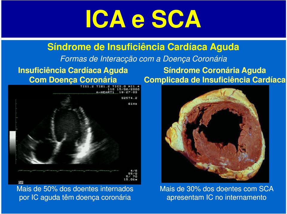 Síndrome Coronária Aguda Complicada de Insuficiência Cardíaca Mais de 50% dos doentes